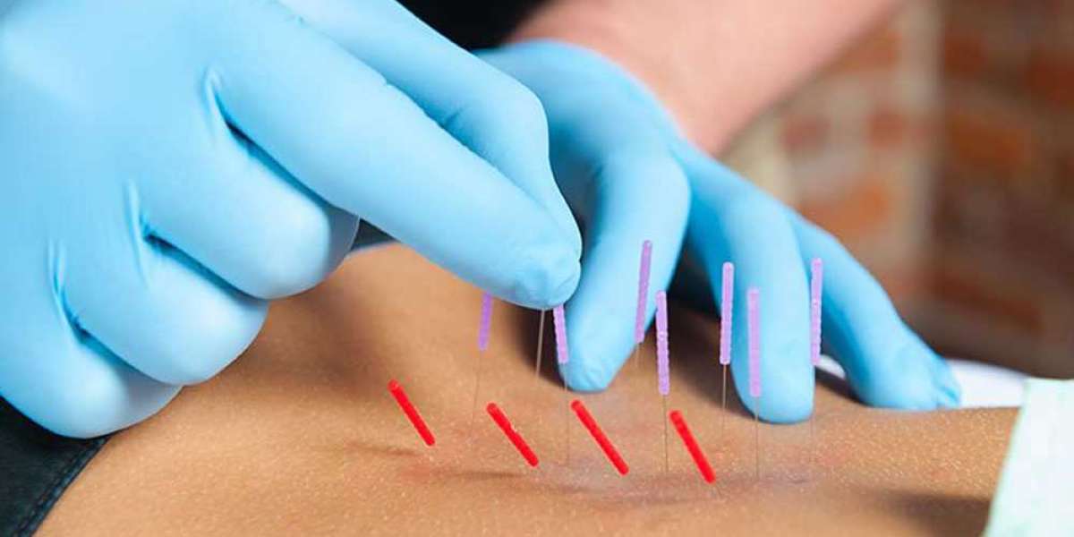 Dry Needling Therapy for Muscle Pain