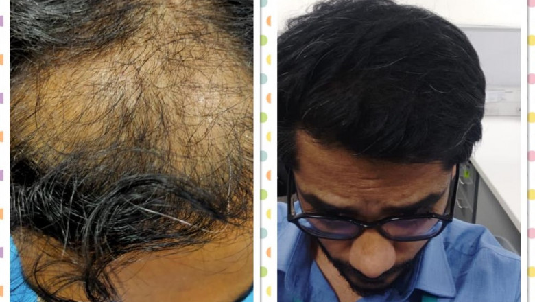 Get the Best Hair with Effective Dandruff Treatment in Bangalore