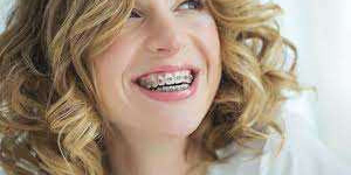 Factors That Influence the Cost of Braces Without Insurance